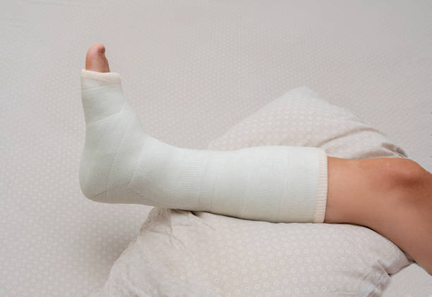 istock Broken leg. Ankle and foot splint Bandages on the legs. 1424471228