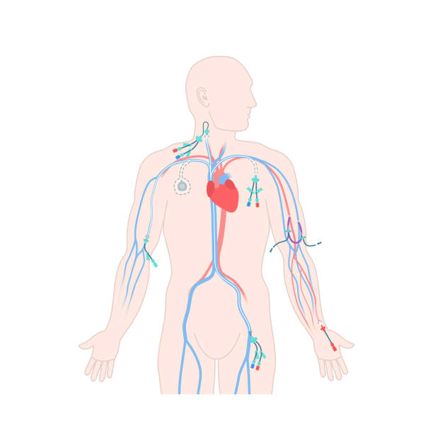 男性の体の中心線静脈カテーテルタイプ - surgery catheter cardiac catheterization hospital点のイラスト素材／クリップアート素材／マンガ素材／アイコン素材