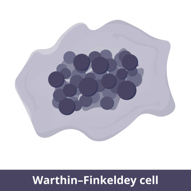 Warthin–Finkeldey cell. Giant multinucleate cell found in hyperplastic lymph nodes early in the course of measles and also in HIV-infected individuals. measles illustrations stock illustrations