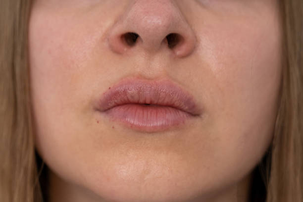 istock woman lips push up close up view after lip augmentation procedure with fillers, increase lips hyaluronic acid, visible place of needle injection marks, swelling after cosmetic procedure, cosmetician, big lips, contour plastic 1425116616