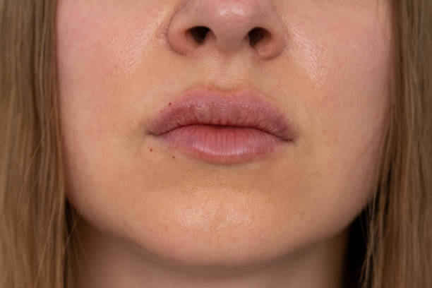 istock woman lips push up close up view after lip augmentation procedure with fillers, increase lips hyaluronic acid, visible place of needle injection marks, swelling after cosmetic procedure, cosmetician, big lips, contour plastic 1425116628