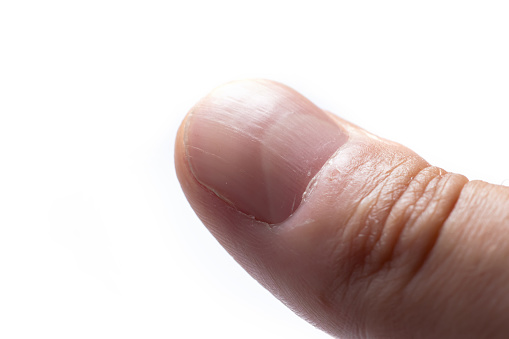 Uña estriada de un dedo pulgar de un hombre con crestas verticales sobre fondo blanco photo