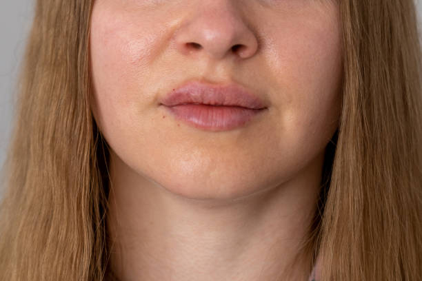 istock woman lips push up close up view after lip augmentation procedure with fillers, increase lips hyaluronic acid, visible place of needle injection marks, swelling after cosmetic procedure, cosmetician, big lips, contour plastic 1425198364