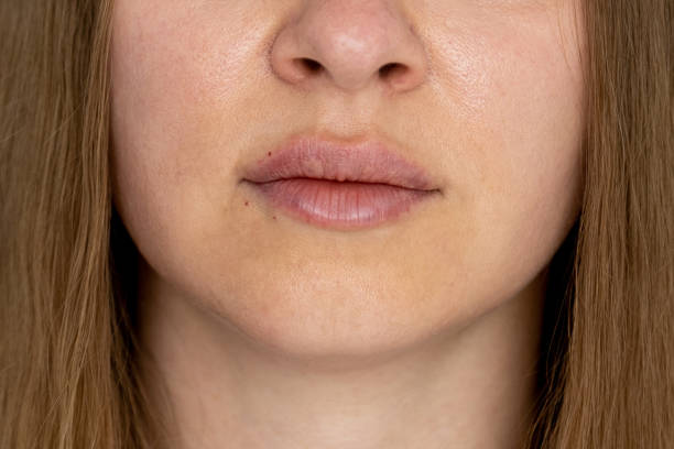 istock woman lips push up close up view after lip augmentation procedure with fillers, increase lips hyaluronic acid, visible place of needle injection marks, swelling after cosmetic procedure, cosmetician, big lips, contour plastic 1425198367