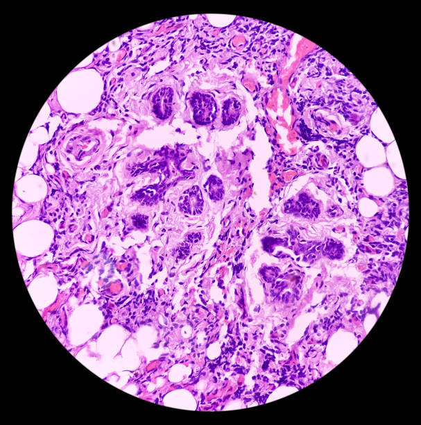 microfotografía de la glándula parótida, parotiditis crónica, muestra tejido parótido de inflamación crónica. parotiditis crónica recurrente. - salivary gland fotografías e imágenes de stock