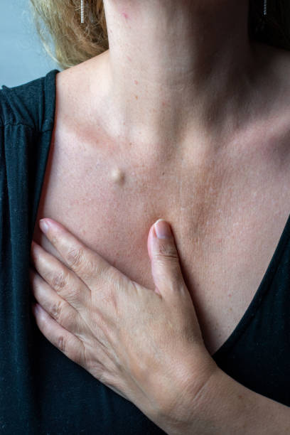 A sebaceous cyst fatty lump on a woman’s chest skin - dermatology problems stock photo