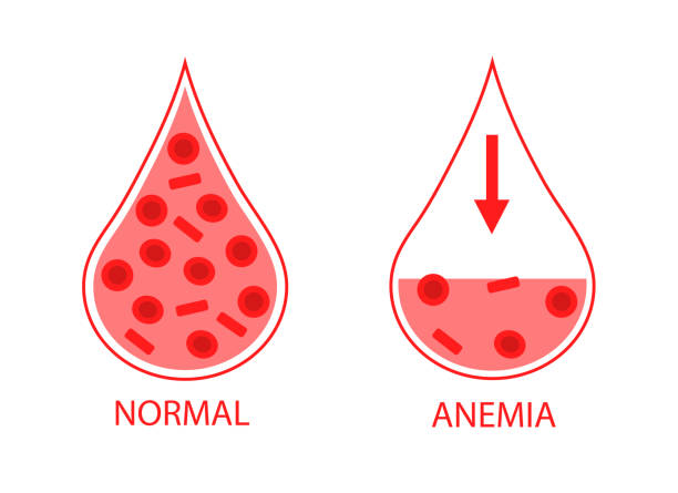 ilustraciones, imágenes clip art, dibujos animados e iconos de stock de comparando dos gotas de sangre de células sanguíneas normales y anémicas. hemoglobina baja. imagen aislada sobre fondo blanco. - blood blood donation blood cell drop