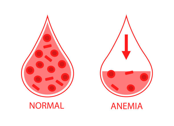 illustrations, cliparts, dessins animés et icônes de comparaison de deux gouttes de cellules sanguines normales et anémiques. faible taux d’hémoglobine. image isolée sur fond blanc. - red blood cell