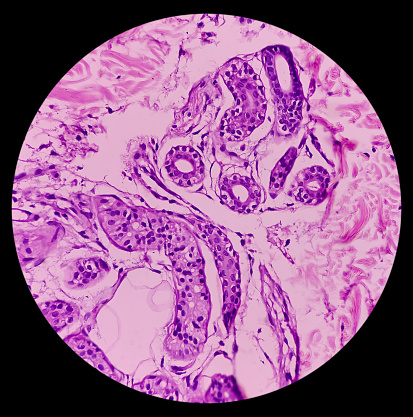 Tejido de la piel (biopsia): Pitiriasis liquenoides crónicos, un grupo de trastornos inflamatorios de la piel adquiridos raros. La epidermis muestra hiperqueratosis leve y acantosis, exocitosis focal de linfocitos. photo