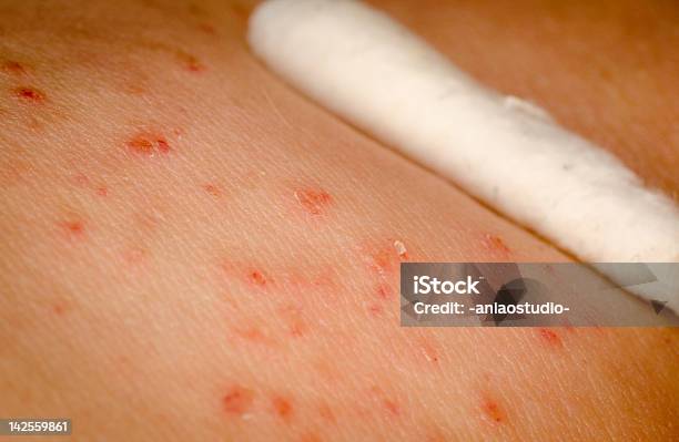 Aplicação Tópica Do Medicamento Na Pele Do Eczema - Fotografias de stock e mais imagens de Cotonete - Cotonete, Doutor, Alergia