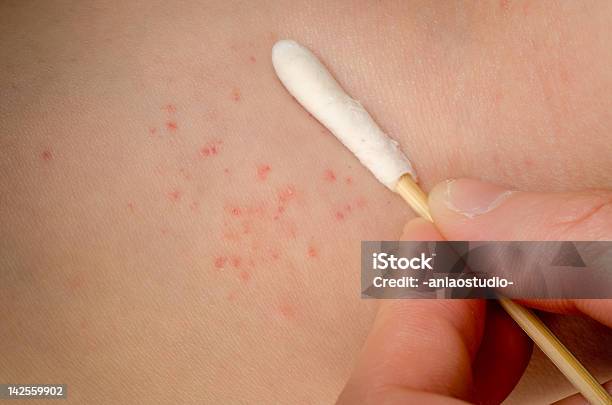 Miejscowe Stosowanie Leków Na Egzemę Skin - zdjęcia stockowe i więcej obrazów Patyczek kosmetyczny - Patyczek kosmetyczny, Rana, Alergia