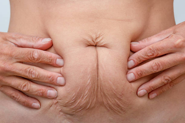 les mains sur le ventre pressent la peau pour montrer le relâchement cutané après le régime et les vergetures après la grossesse - resserrer photos et images de collection