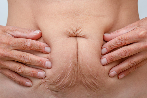 Cropped woman hands on belly pressed skin to show sagging skin after diet and stretch marks after pregnancy