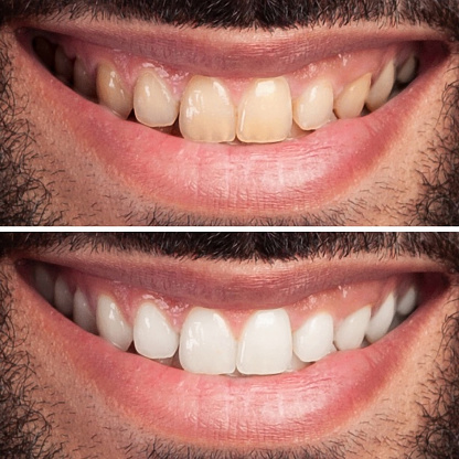 Dientes de mujer antes y después del blanqueamiento. Feliz mujer sonriente. Concepto de salud dental. Concepto de cuidado bucal photo