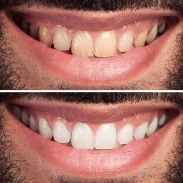Woman Teeth Before and After Whitening. Happy smiling woman. Dental health Concept. Oral Care concept stock photo
