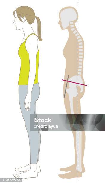 Bad Standing Position A Woman With A Bad Posture Standing Flat And Her Skeleton Stock ...