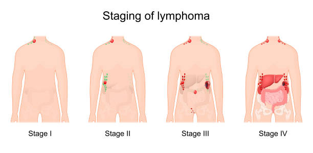 lymphom-stadium. krebs des lymphsystems. - hodgkins disease stock-grafiken, -clipart, -cartoons und -symbole