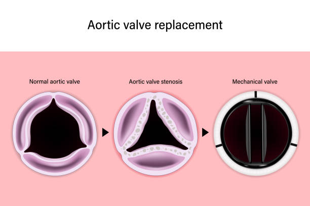 illustrations, cliparts, dessins animés et icônes de remplacement de la valve aortique. valve aortique normale. sténose valvulaire aortique. vanne mécanique. réparation de valve aortique. - valvule cardiaque