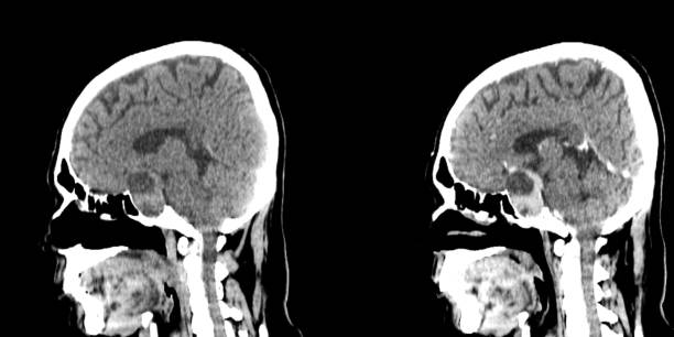 istock head ct scan of Sellar masses 1426908218