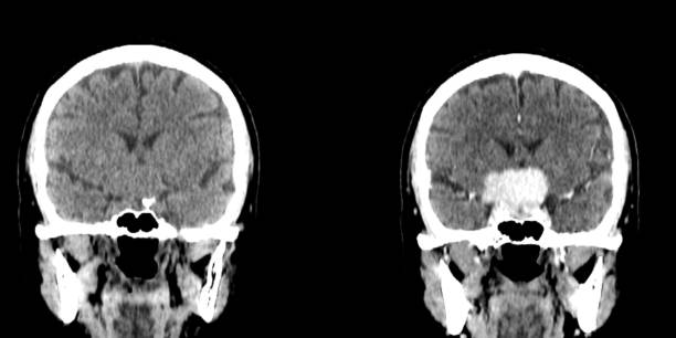 istock head ct scan of Sellar masses 1426908308