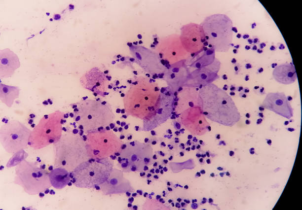 istock Microscopic view of PAP'S smear showing severe negative for intraepithelial lesion malignancy (NILM). cervical cancer diagnosis. 1426956096