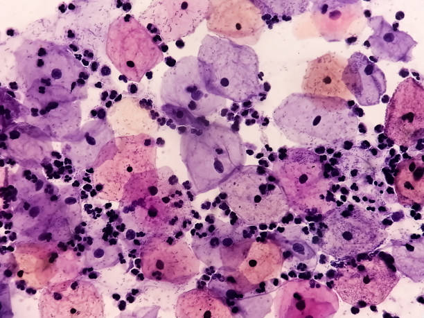 mikroskopijny widok rozmazu pap wykazujący ciężki negatywny wynik na złośliwość zmian śródnabłonkowych (nilm). diagnoza raka szyjki macicy. - cytologia zdjęcia i obrazy z banku zdjęć