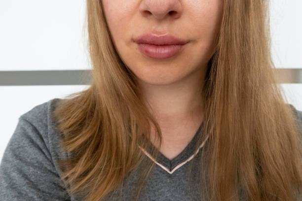 istock woman lips close up view after lip augmentation procedure with fillers, increase lips hyaluronic acid, visible place of needle injection marks, swelling after cosmetic procedure, cosmetician treatment 1427118837