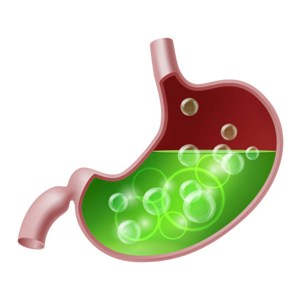 Stomach suffering from acid reflux. Gastroesophageal reflux disease. Stomach suffering from acid reflux. Gastroesophageal reflux disease. Digestive system Acidity or Upset problem. Medical vector illustration . pyloric sphincter stock illustrations