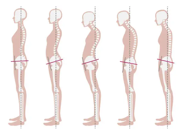 Vector illustration of Skeletal sample of good and bad posture