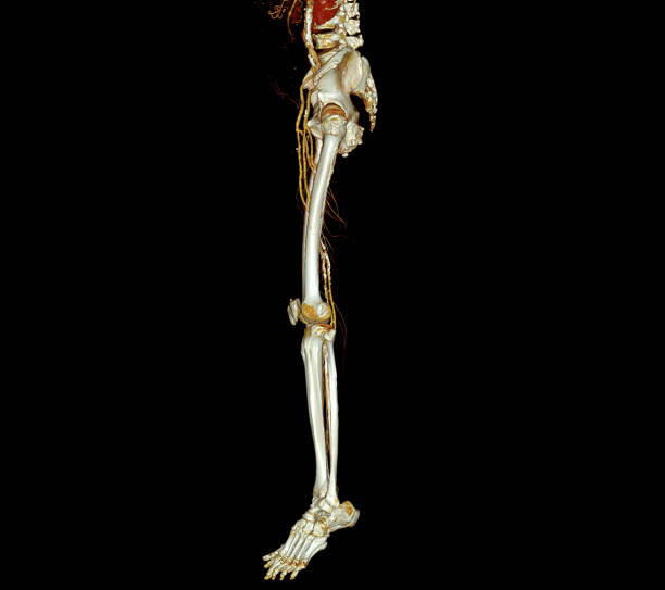 istock CTA femoral artery run off  3D rendering i. 1427260058