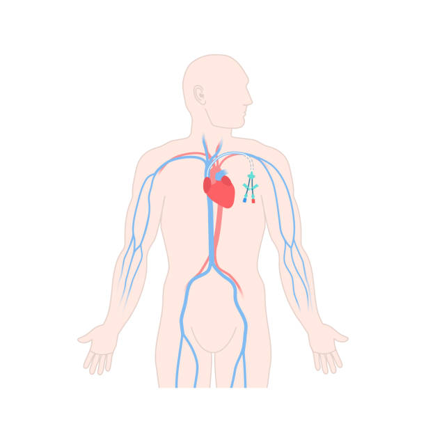 ilustraciones, imágenes clip art, dibujos animados e iconos de stock de catéter venoso de línea central tunelizado en el cuerpo masculino - surgery catheter cardiac catheterization hospital