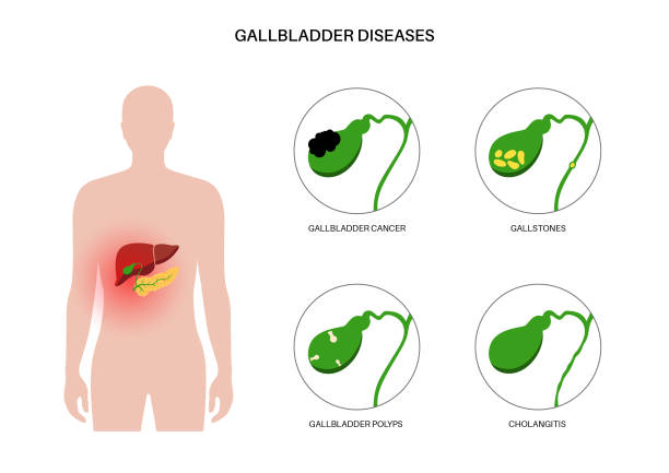 Gallbladder diseases poster Gallbladder diseases infographic. Gallstone, cancer, acute cholecystitis, PSC or polyps the digestive system. Biliary ducts problems. Common cause of abdomen inflammation, flat vector illustration. gall bladder stock illustrations