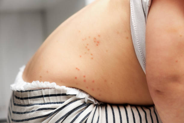 rücken eines kleinen kindes mit rotem hautausschlag. baby mit roten flecken blasen auf der haut. nahaufnahme von schmerzhaftem hautausschlag. gesundheitsproblem. röteln, windpocken, scharlach, masern. bakterielle infektionen, krankheiten. - chickenpox skin condition baby illness stock-fotos und bilder