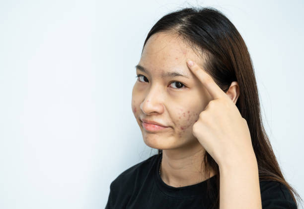 istock Asian woman pointing to acne problems inflamed on her forehead. 1428021647