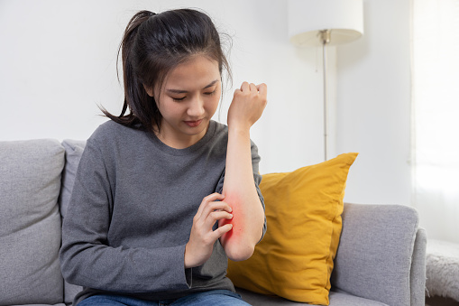 Asian Woman Scratching her Arm Suffer from Allergy Itchy Skin