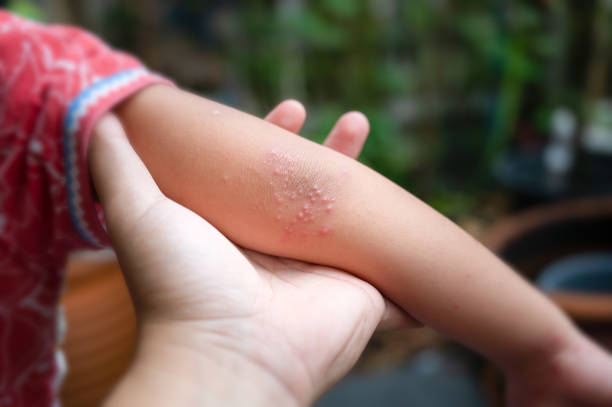 Rash on the elbow of the Hand foot and mouth disease. Hand-foot-and-mouth disease is most commonly caused by a coxsackievirus and Enterovirus. Rash on the elbow of the Hand foot and mouth disease. Hand-foot-and-mouth disease is most commonly caused by a coxsackievirus and Enterovirus. hand foot and mouth disease stock pictures, royalty-free photos & images