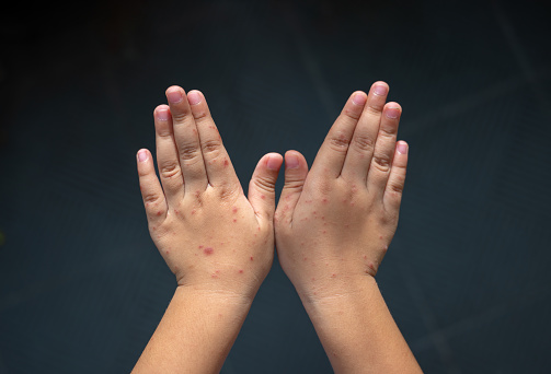 Erupción en las manos de la enfermedad de manos, pies y boca. La enfermedad mano-pie-boca es causada más comúnmente por un coxsackievirus y Enterovirus. photo
