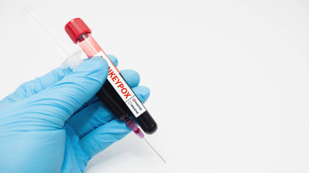 istock Epidemic concept of monkeypox virus, gloved hands, holding syringes and blood sampling tubes. 1428385447