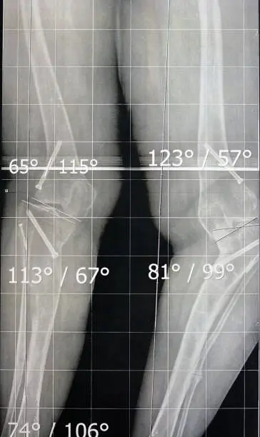 Plain x ray long film standing position showing both legs with bilateral metaphyseal genu varum, previous epiphysiodesis, left distal femur valgus and left medial tibial plateau depression, selective focus