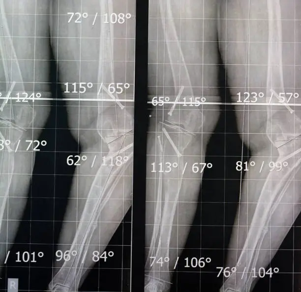 Plain x ray long film standing position showing both legs with bilateral metaphyseal genu varum, previous epiphysiodesis, left distal femur valgus and left medial tibial plateau depression, selective focus