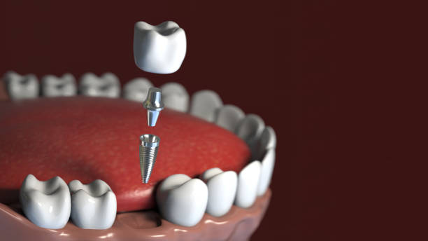 instalação de implante dentário. reconstruir o dente. tratamento do canal radicular. - dental implant dental hygiene dentures prosthetic equipment - fotografias e filmes do acervo