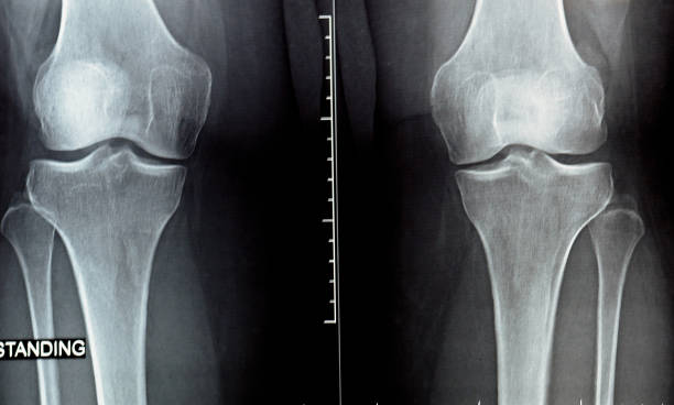 istock plain x ray on knee joint showing joint space narrowing and Subchondral Sclerosis on medial compartment (thickening of bone that happens in joints affected by osteoarthritis), knee osteoarthritis 1428631924