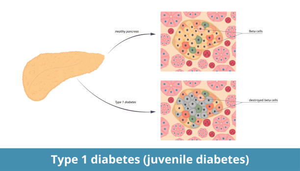 ilustrações, clipart, desenhos animados e ícones de diabetes tipo 1 (diabetes juvenil). - célula alfa