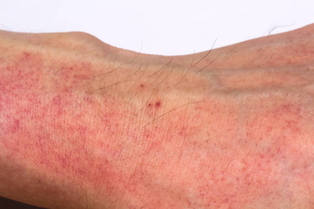istock Wrist asian man with allergy red rash on white background 1428922542