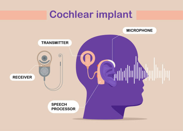 ilustraciones, imágenes clip art, dibujos animados e iconos de stock de el dispositivo de implante coclear estimula eléctricamente el nervio ayuda médica oído oído onda sonora adultos examen medio duro. - listening people human ear speaker