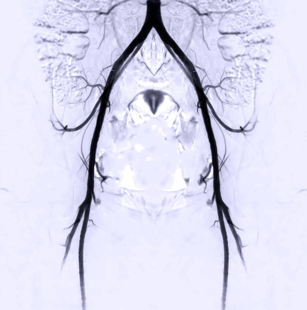 Femoral Angiogram of femoral artery. stock photo