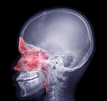 Skull x-ray image fusion with paranasal sinuses 3D rendering.