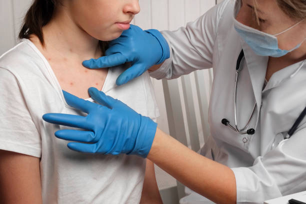 médico revisando la piel de una niña enferma. niño con erupción roja siendo examinado en el médico. erupción alérgica, varicela, síntomas de viruela del mono en el cuerpo del niño. problema de salud. infecciones bacterianas, enfermedad - cholera bacterium fotografías e imágenes de stock