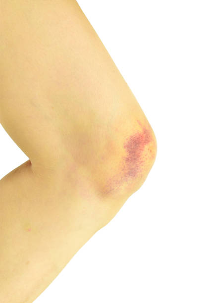 knee contusion isolated on white background with clipping path knee contusion isolated on white background with clipping path, Wounded Knee domestic violence india stock pictures, royalty-free photos & images