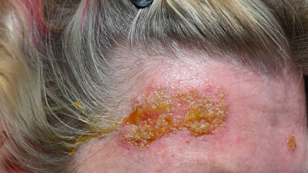 istock Skin cancer treatment 1429179524